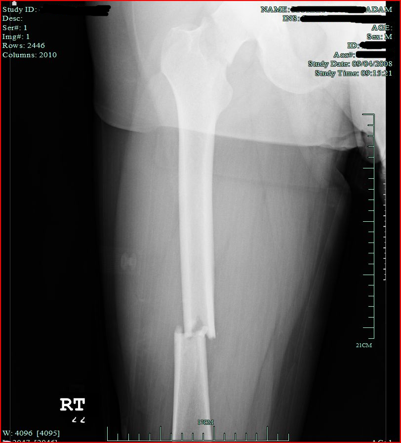 Fractured Femur